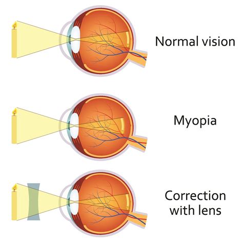 mypoea|what is considered severe myopia.
